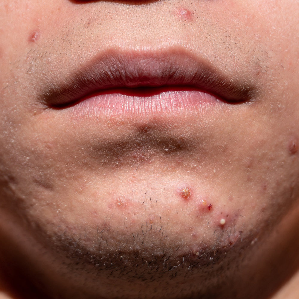 Natuurlijke verzorging bij acne voor mannen van InaEssentials