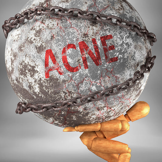 Natuurlijke verzorging bij stressacne van InaEssentials